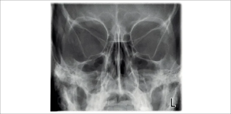PA sinus (Planmeca ProMax 2D 2S)