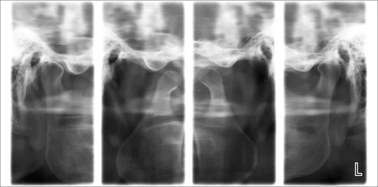Lateral TMJ (closed & open)
