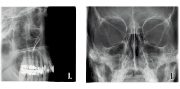 Lateral and PA sinus (Planmeca ProMax 2D S3)