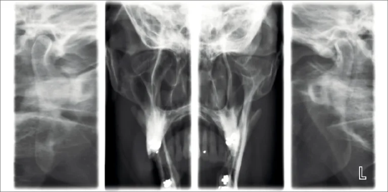 Lateral-PA TMJ (Planmeca ProMax 2D S3)