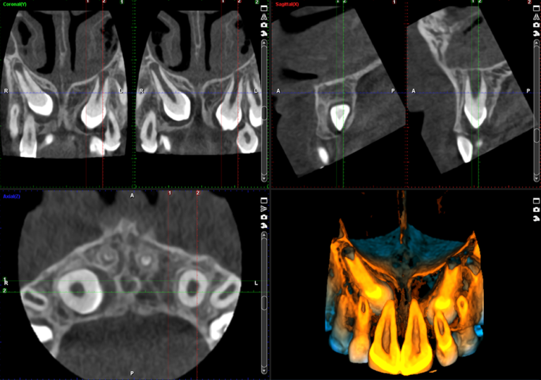 Impacted canine