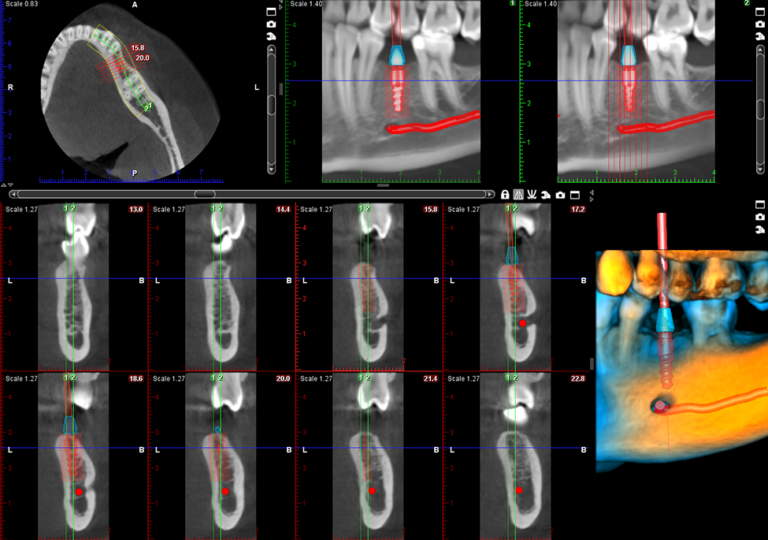 Implant case