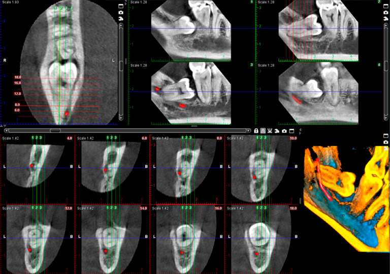 Wisdom tooth