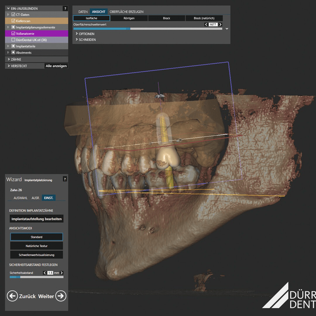 VistaSoft-exocad-Implant